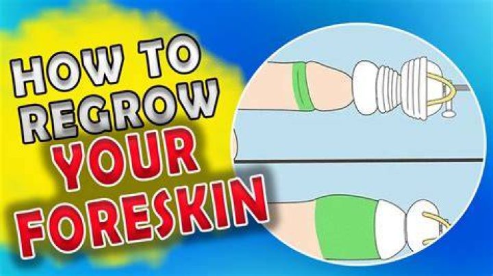 Can you get your foreskin removed at 18?