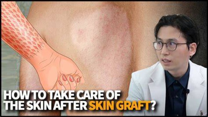 Can you go home after skin graft?