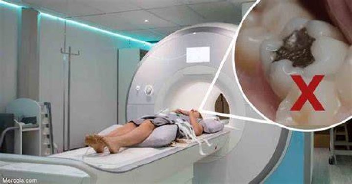 Can you have an MRI if you have fillings in your teeth?