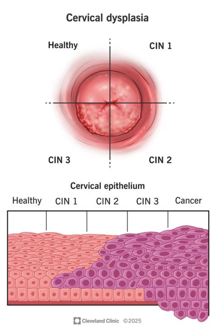Can you have CIN 1 without HPV?