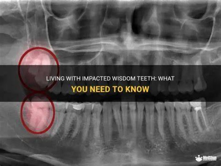 Can you live with impacted wisdom teeth?