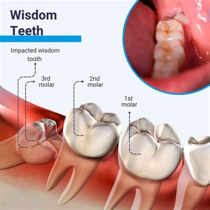 Can you live with your wisdom teeth?
