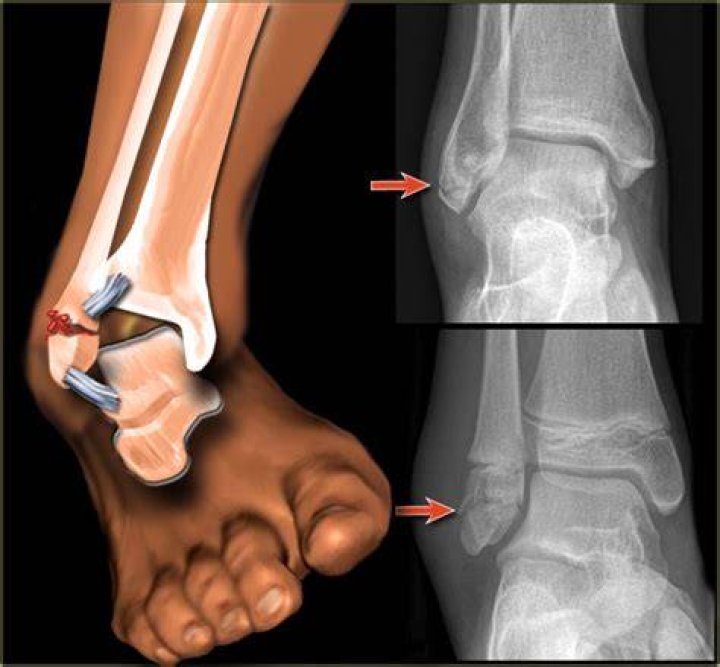 Can you move your ankle if it's fractured?
