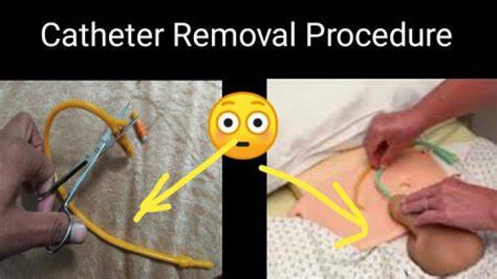 Can you remove catheter yourself?