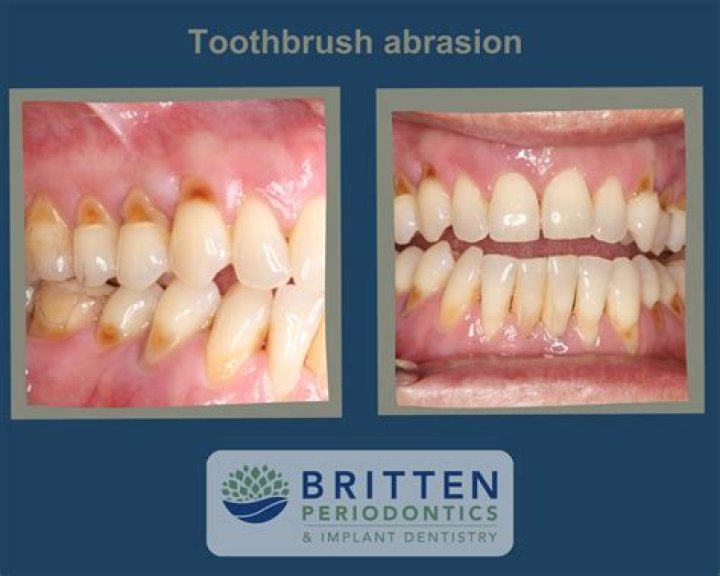 Can you reverse tooth abrasion?