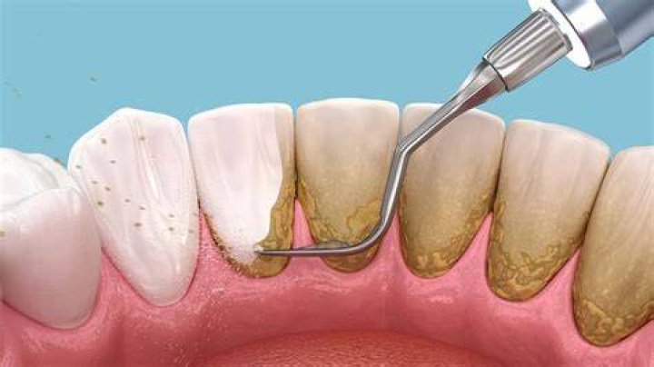Can you scrape the plaque off your own teeth?