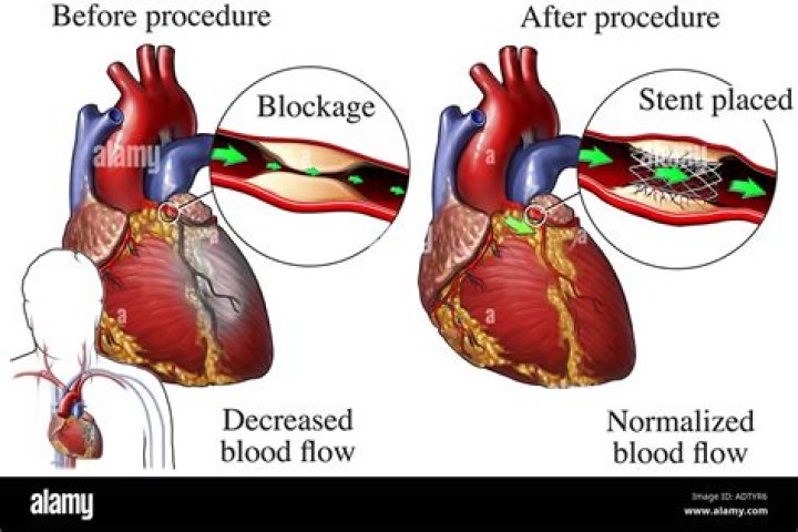 Can you Stent a 100% blocked artery?