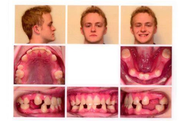 Can you survive without teeth?