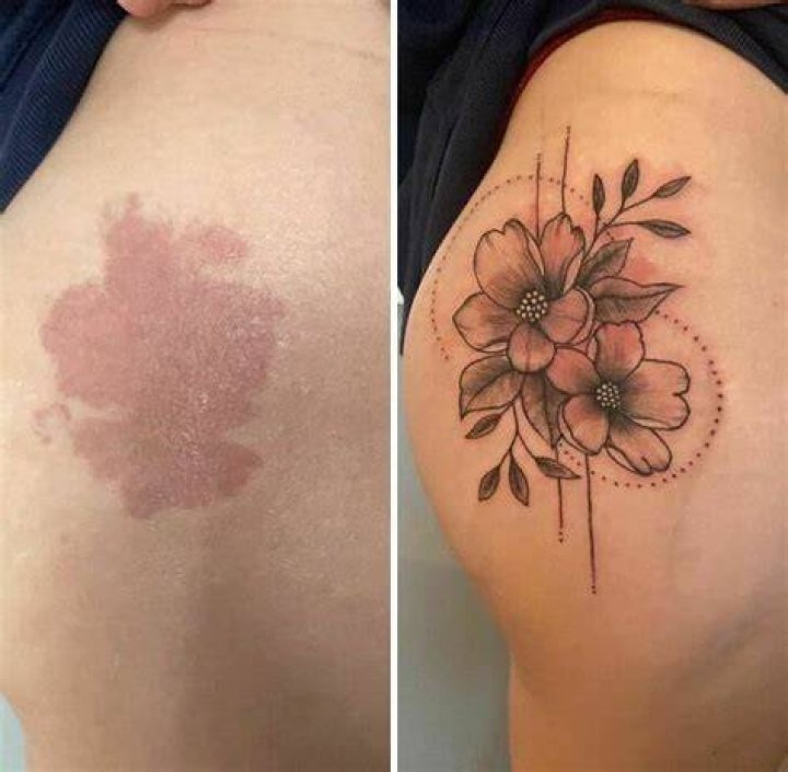 Can you tattoo over birthmark?