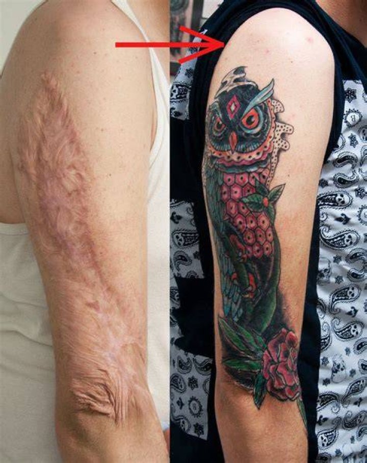 Can you tattoo over razor burn?