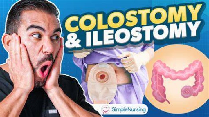 Can you walk after colostomy surgery?