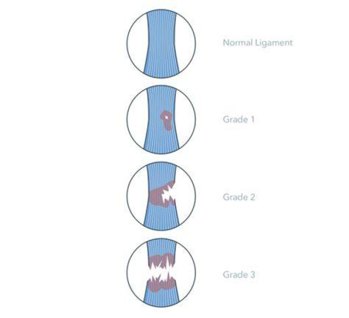 Can you walk on a grade 3 ACL tear?