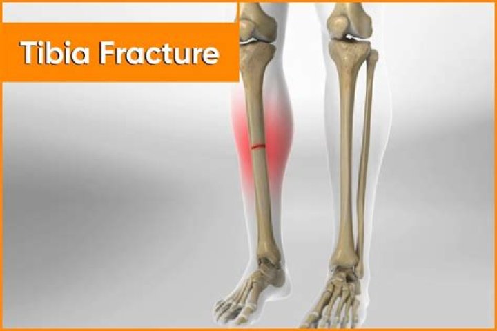 Can you walk with tibia fracture?