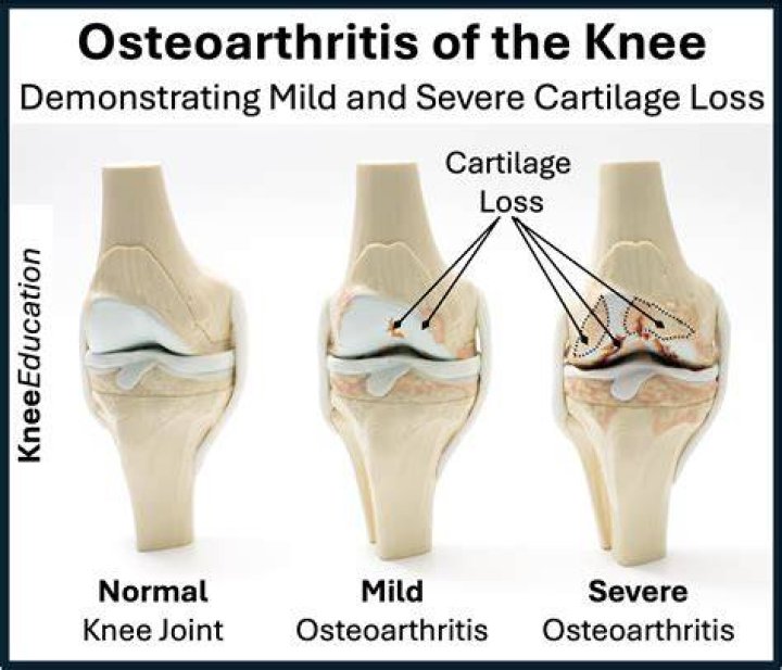 Can you work if you have osteoarthritis?