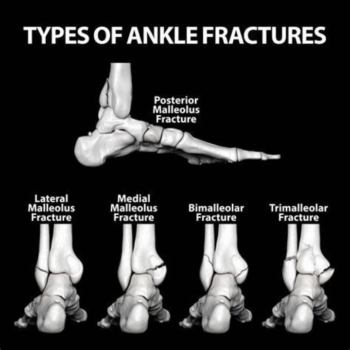 Do all ankle fractures need surgery?