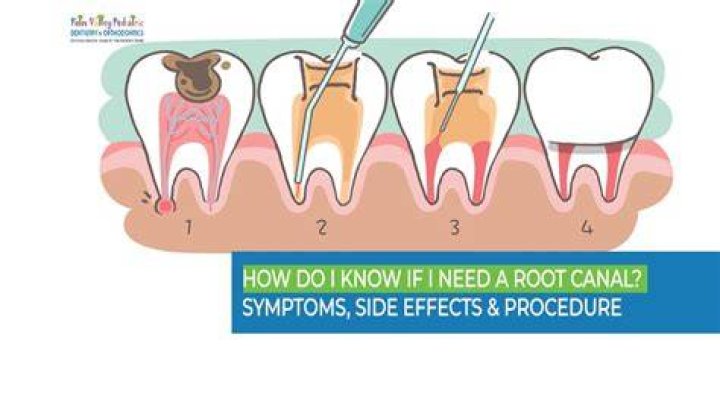 Do all cavities need root canals?