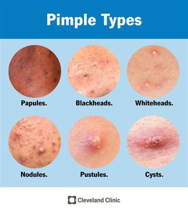 Do all pimples come to a head?