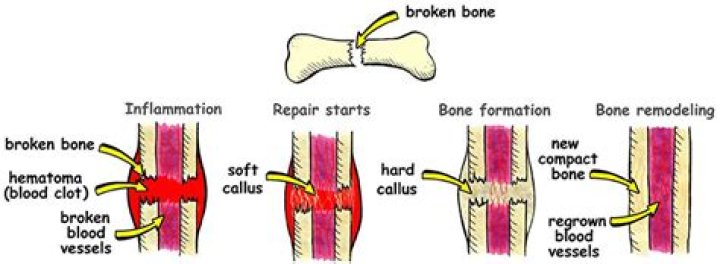 Do bones grow back after broken?