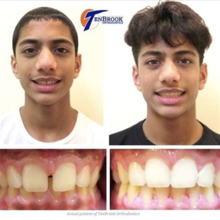 Do braces cause weight loss?