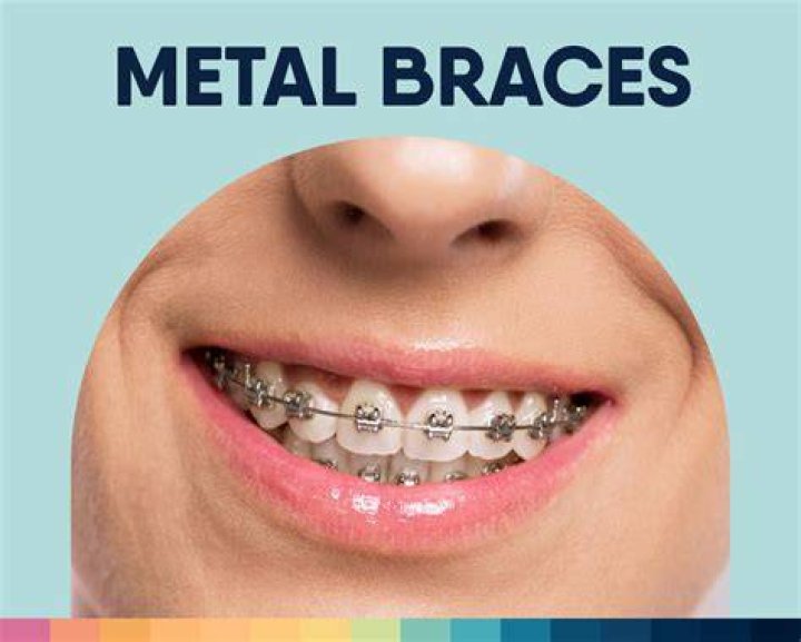 Do braces get easier?