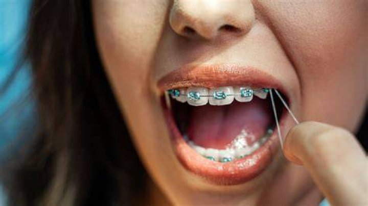 Do braces have a taste?