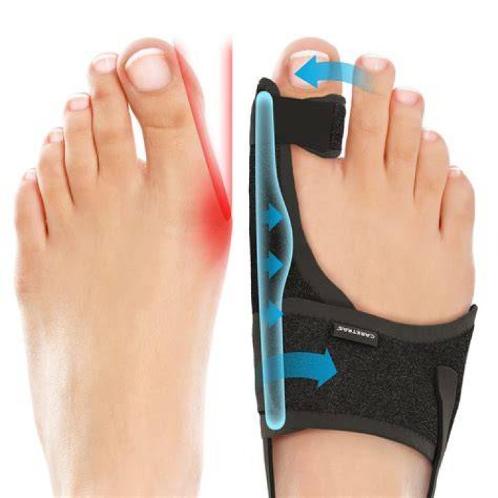 Do braces help bunions?