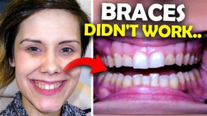 Do braces make your teeth worse at first?