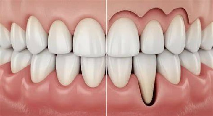 Do burnt gums grow back?