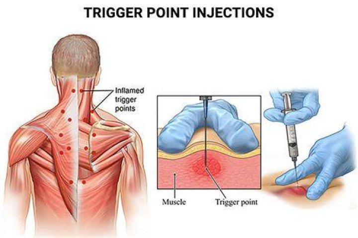 Do chiropractors give trigger point injections?