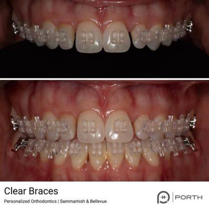 Do clear braces look weird?