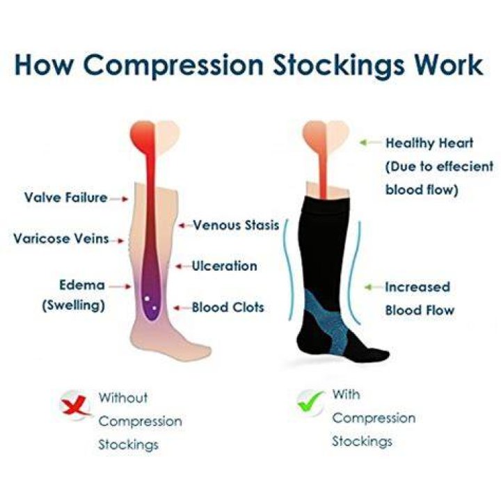 Do compression socks help edema?