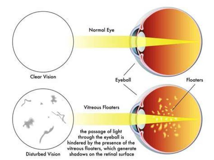 Do eye floaters cause blurry vision?