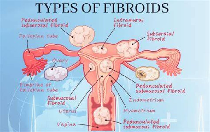 Do fibroids affect you mentally?
