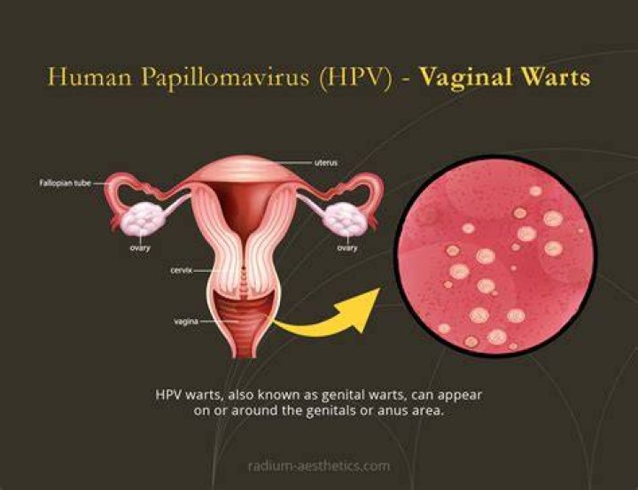 Do HPV bumps go away?