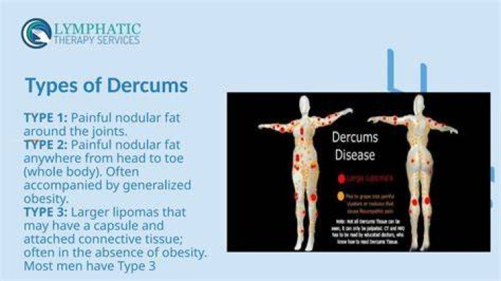 Do I have Dercums disease?