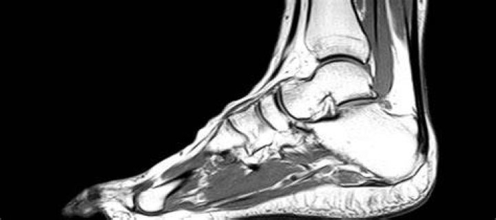 Do I need an MRI for a sprained ankle?