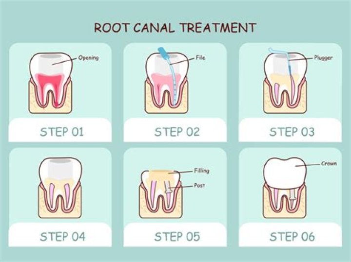 Do I need antibiotics after a crown?