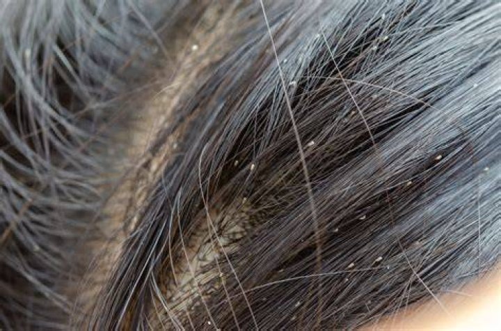 Do lice like bleached hair?