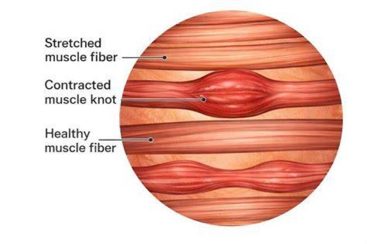 Do muscle knots feel like lumps?