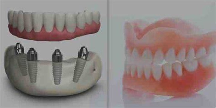 Do permanent dentures fit better than temporary dentures?
