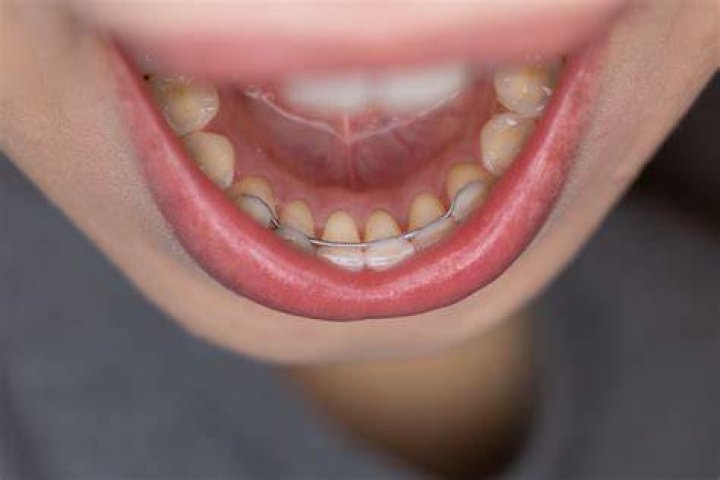 Do permanent retainers affect kissing?