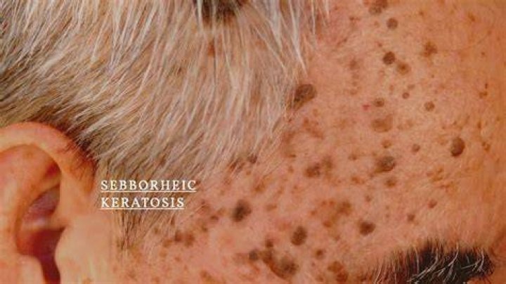 Do seborrheic keratosis grow over time?