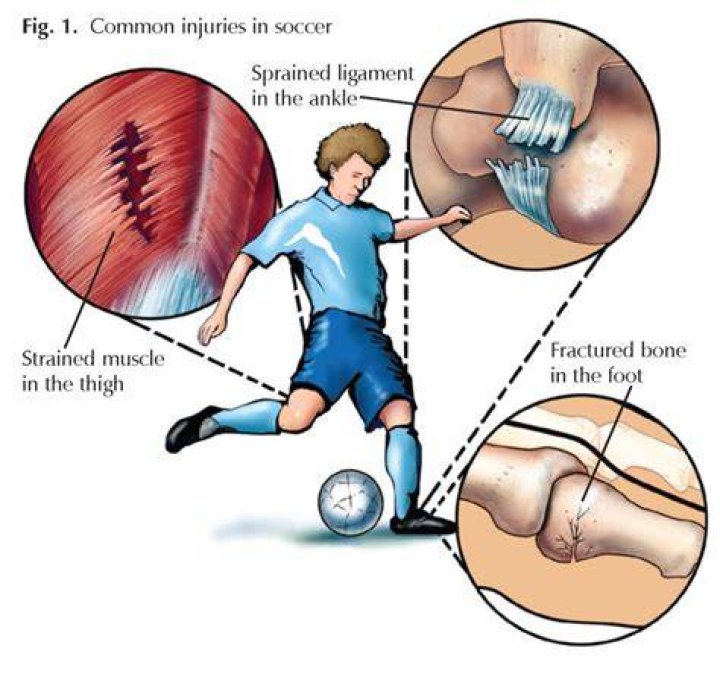 Do sprains get worse before they get better?
