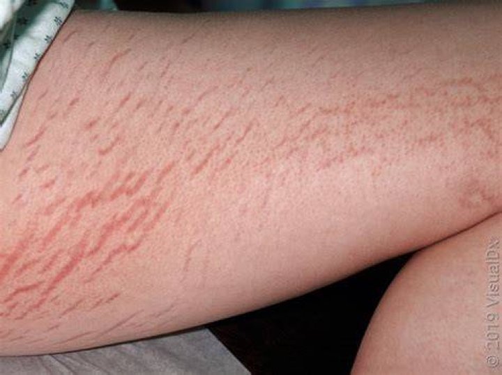 Do stretch marks on thighs go away?
