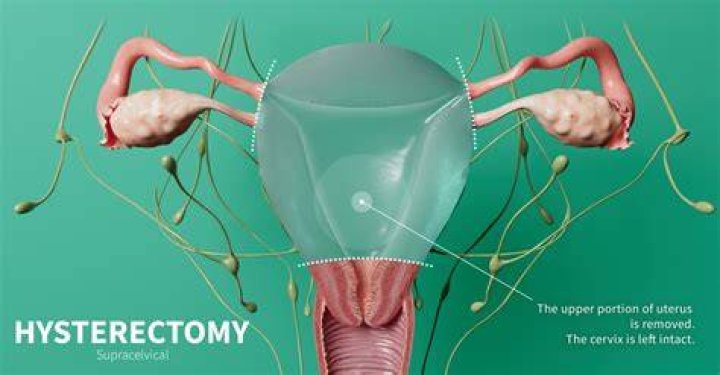 Do they cut your stomach muscles during a hysterectomy?