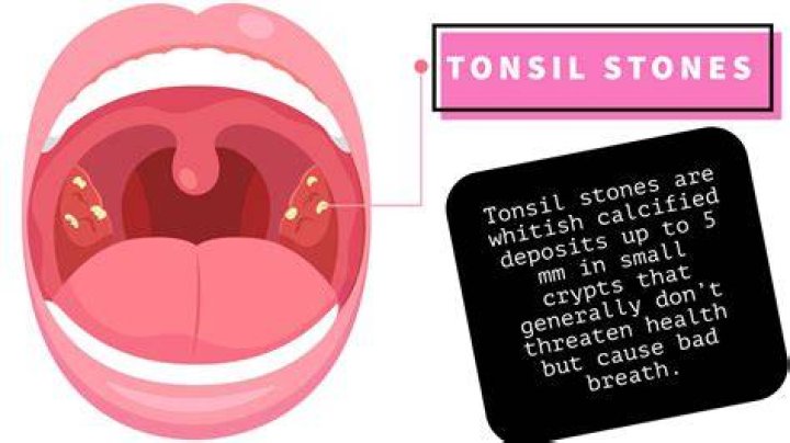 Do tonsil stones eventually fall out?