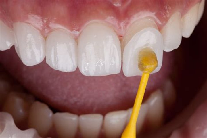 Do veneers go yellow?