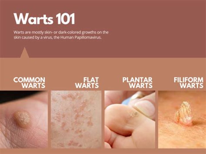 Do warts feed on sugar?