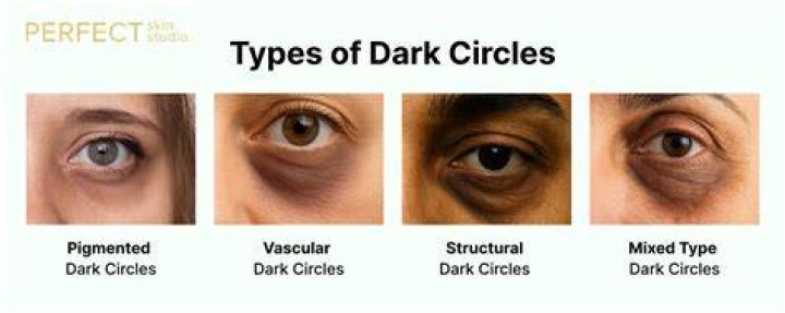 Do worms cause dark circles?