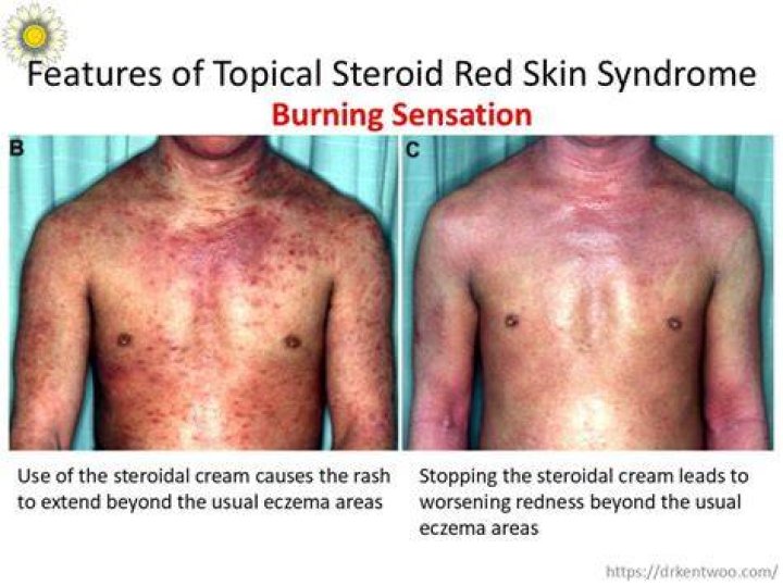 Do you always get steroids with chemo?